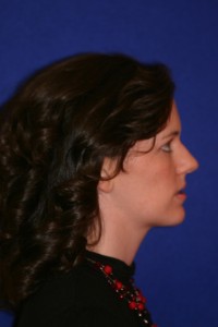 Profile with my lower jaw jutting forward. This was taken to demonstrate how my profile was likely to change with surgery.